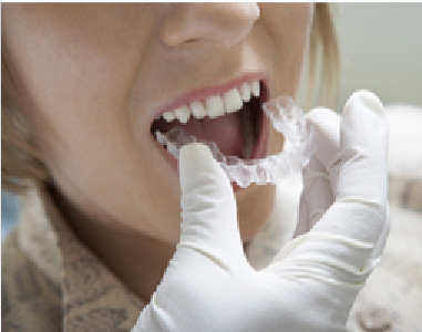 マウスピース装置