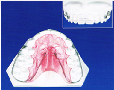 保定装置（リテーナー）