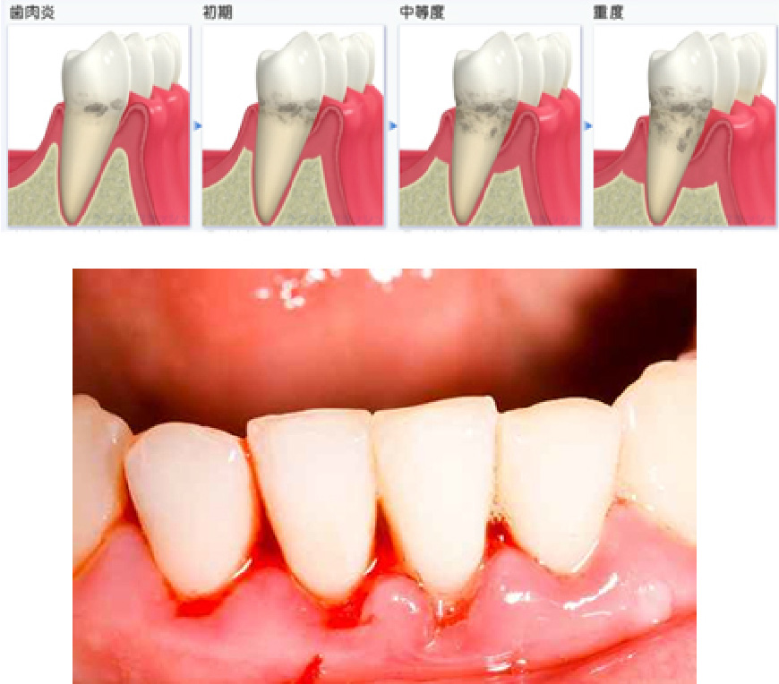 日本における抜歯理由の第1位は歯周病